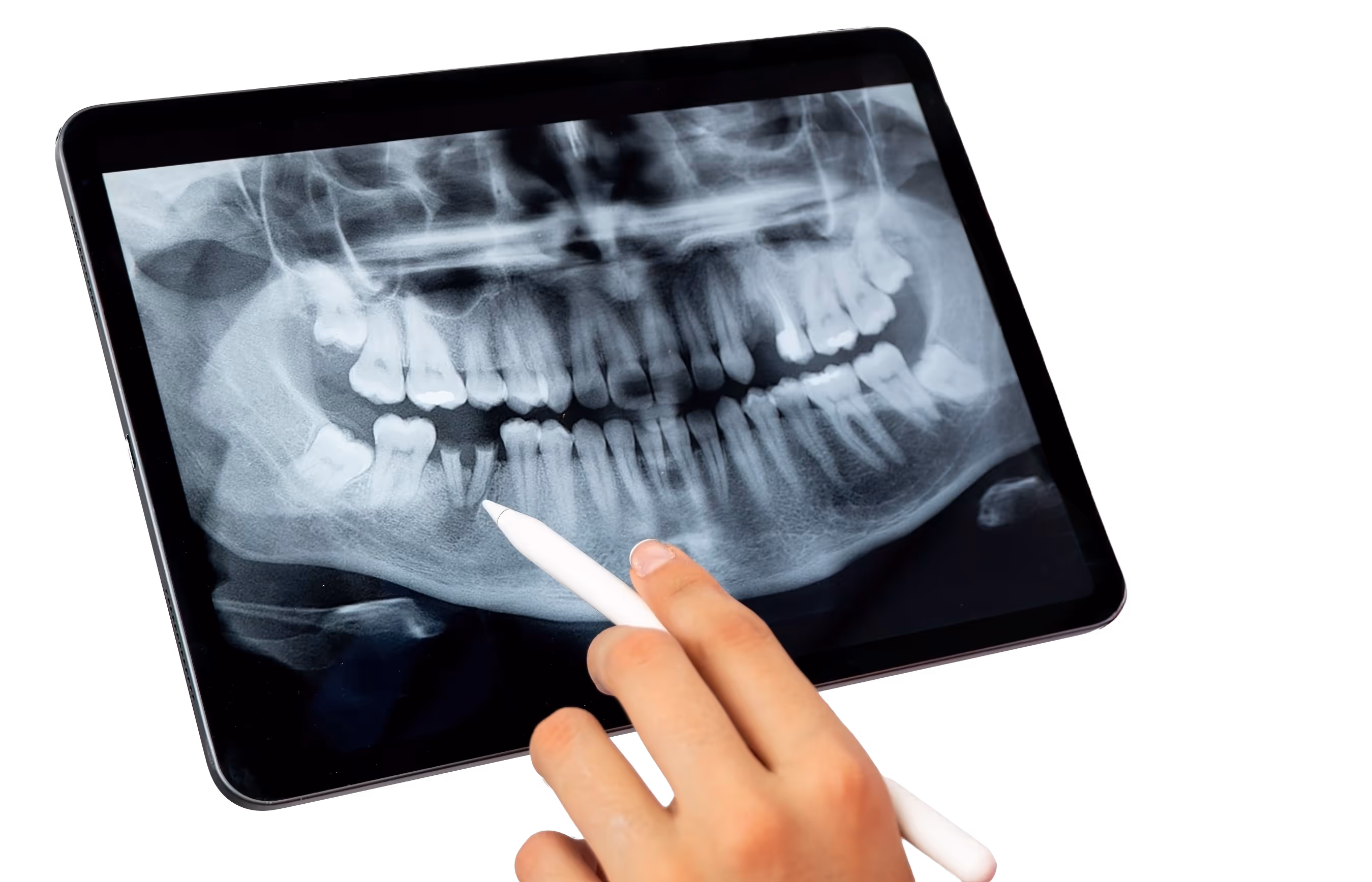 R&ouml;ntgenaufnahme eines menschlichen Kiefers auf einem Tablet, eine Hand h&auml;lt einen wei&szlig;en Stift und zeigt auf die unteren Z&auml;hne.