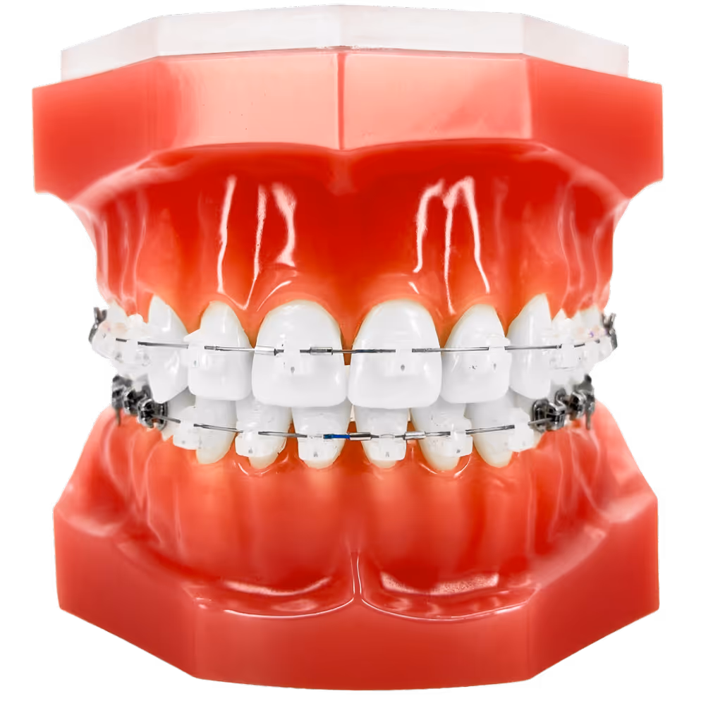 Zahnmodell mit oberer und unterer Zahnreihe, beide mit fester Zahnspange. Frontz&auml;hne mit wei&szlig;en Keramik-Brackets.