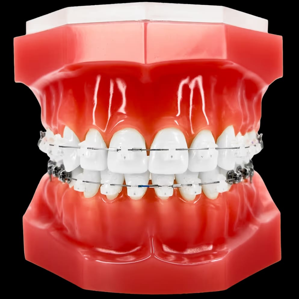 Zahnmodell mit oberer und unterer Zahnreihe, beide mit fester Zahnspange. Frontzähne mit weißen Keramik-Brackets.