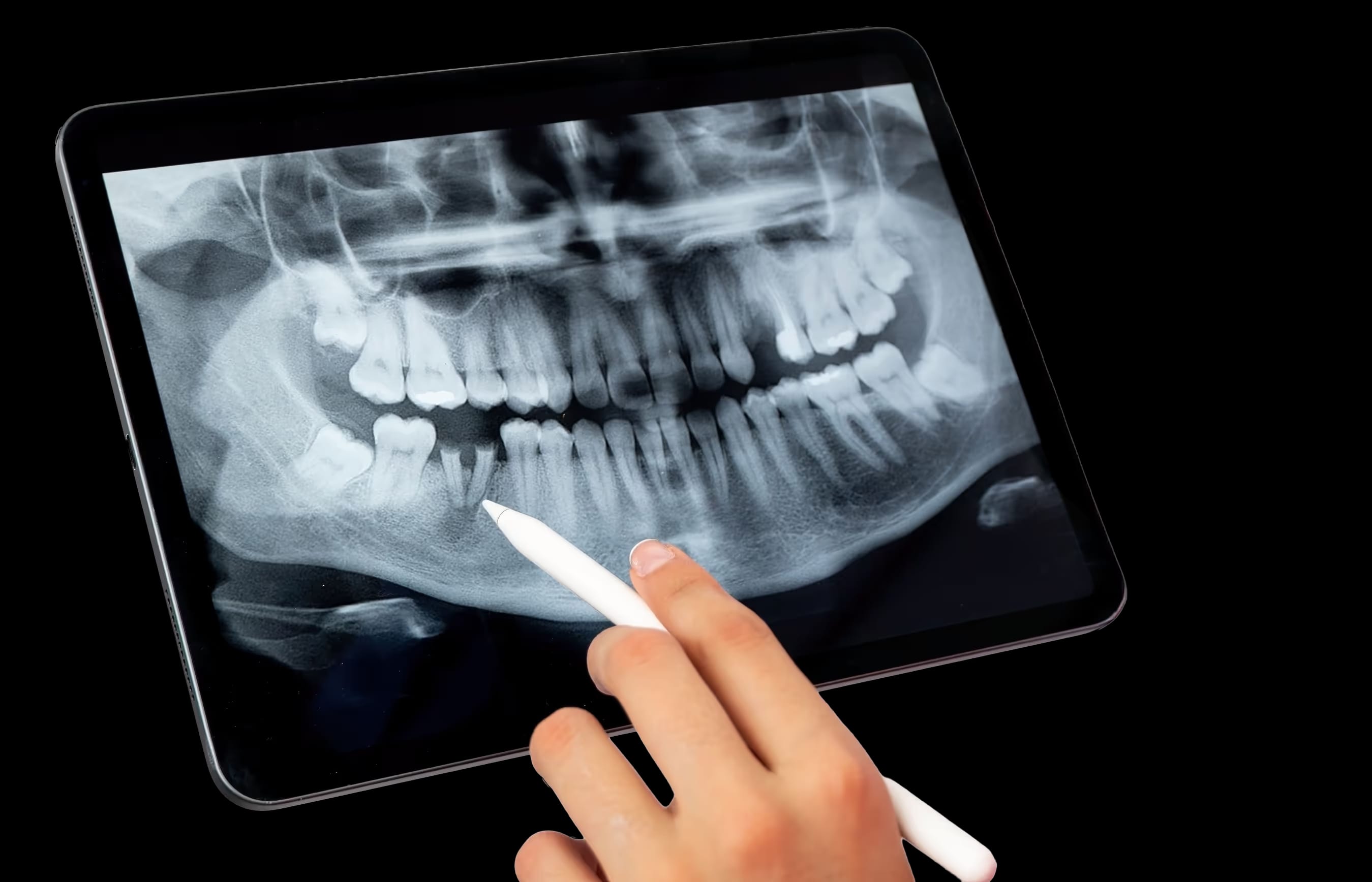 Röntgenaufnahme eines menschlichen Kiefers auf einem Tablet, eine Hand hält einen weißen Stift und zeigt auf die unteren Zähne.