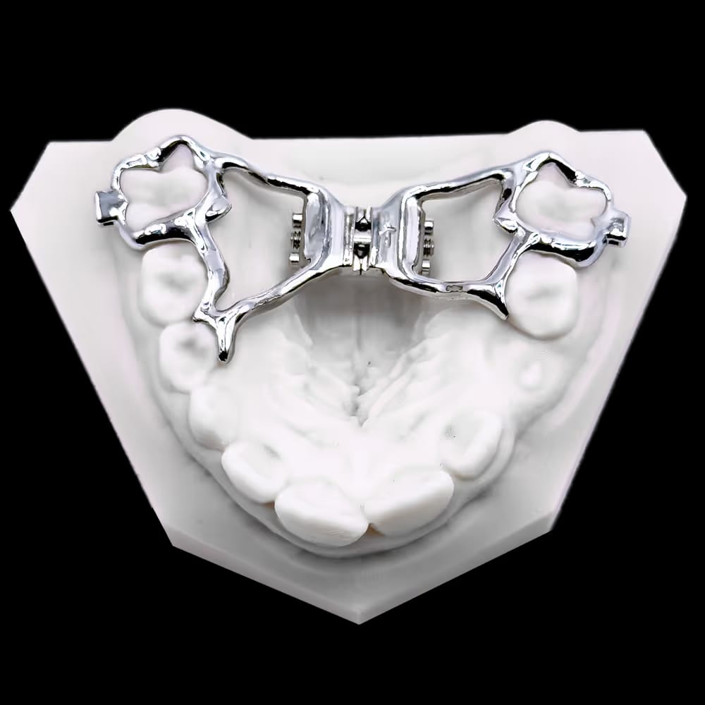 Kieferorthopädische Gaumennahterweiterung aus Metall auf einem Zahnmoulage-Modell des Oberkiefers.